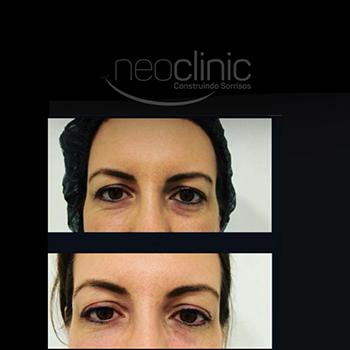 Como é feito preenchimento facial