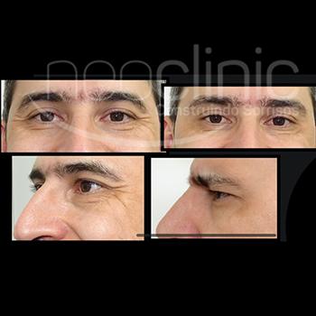 Como funciona o botox facial