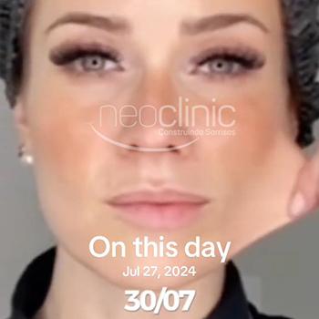 Ultraformer área dos olhos antes e depois